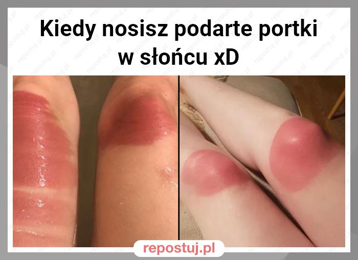 Kiedy nosisz podarte portki w słońcu xD